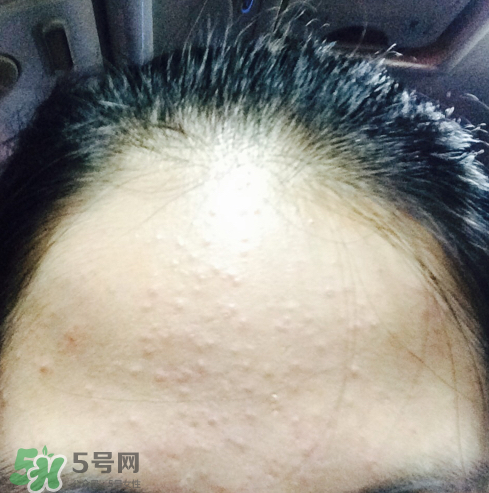 長(zhǎng)痘長(zhǎng)閉口怎么辦？長(zhǎng)痘長(zhǎng)閉口是什么原因？