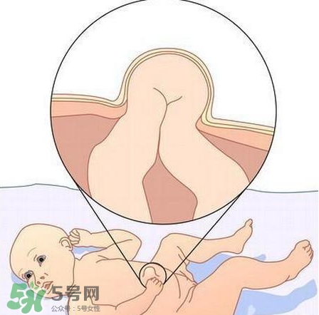 臍疝是什么？臍疝對(duì)寶寶有什么影響？
