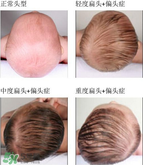 寶寶頭型是睡出來的嗎？寶寶頭型矯正最佳時間