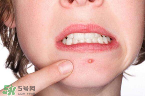 暗瘡可以擠壓嗎？油性和骯臟肌膚會容易有暗瘡嗎？