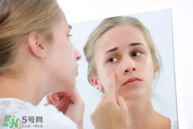 暗瘡可以擠壓嗎？油性和骯臟肌膚會容易有暗瘡嗎？