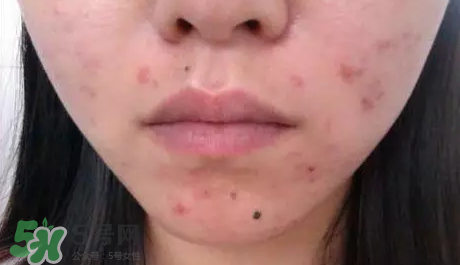 痤瘡和毛囊炎一樣嗎？痤瘡與毛囊炎區(qū)別