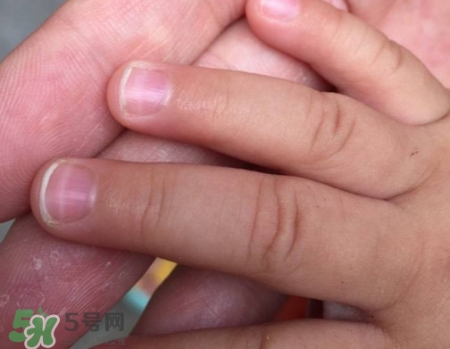 寶寶手指甲有白痕怎么回事？幼兒手指甲發(fā)白是缺鈣嗎