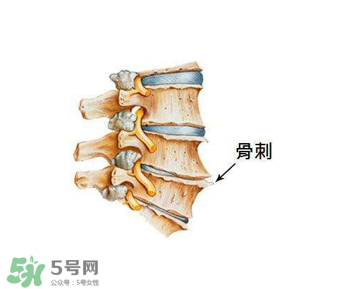 骨刺是怎么形成的？骨刺怎么治療？