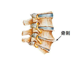 骨刺是怎么形成的？骨刺怎么治療？