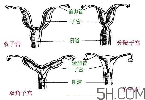 子宮畸形有哪些？子宮畸形有什么影響？