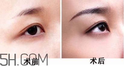 切眉手術后老得快嗎？切眉能保持多久？