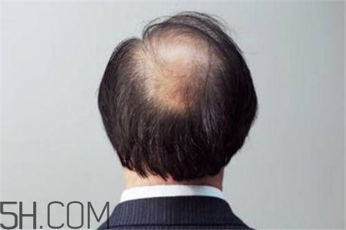 為什么男性比女性更容易脫發(fā)？什么原因?qū)е履行悦摪l(fā)？