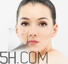 濕熱型痤瘡是什么？怎么調理濕熱型痤瘡？