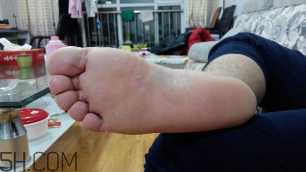 腳氣可以用酒精消毒嗎？腳氣可以用碘伏消毒嗎？