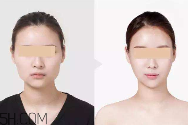 打瘦臉針可以抽煙嗎？打瘦臉針會反彈嗎？