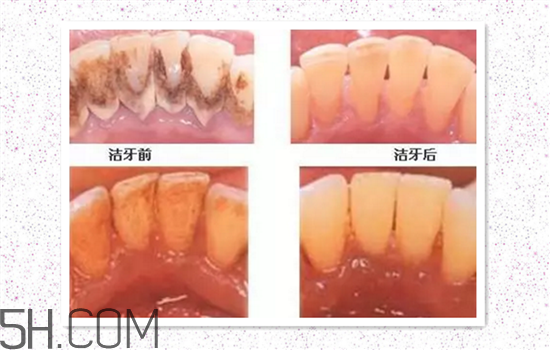 超聲波洗牙可以美白牙齒嗎？超聲波洗牙多少錢一次？