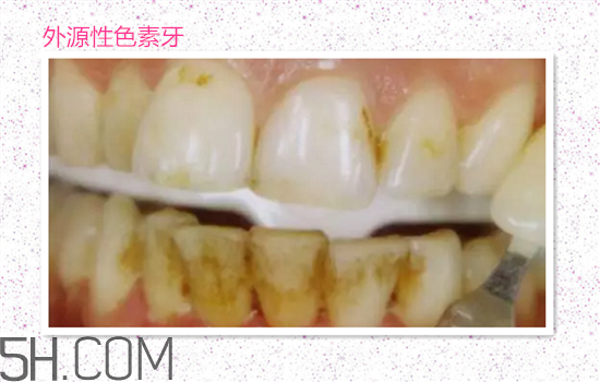 超聲波洗牙可以美白牙齒嗎？超聲波洗牙多少錢一次？