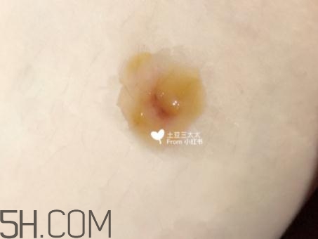 美寶濕潤(rùn)燒傷膏怎么樣？美寶濕潤(rùn)燒傷膏有用嗎？