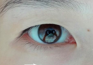 為什么會長脂肪粒？怎么消除眼睛上的脂肪粒？