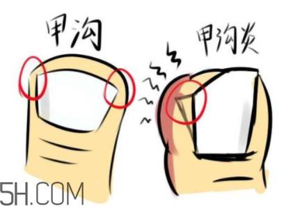 為什么容易得甲溝炎？怎么根治甲溝炎？