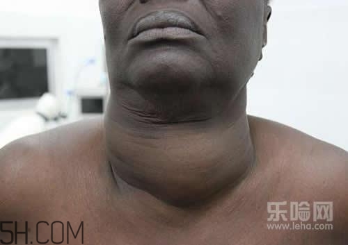 甲狀腺腫大和甲亢的區(qū)別有哪些？甲狀腺腫大適合吃什么食物？