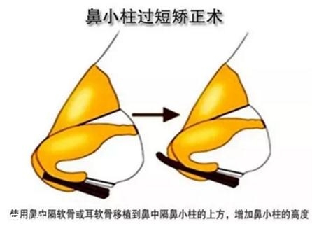 鼻小柱延長用什么材料？優(yōu)先選擇鼻中隔軟骨