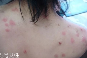 螨蟲有哪些危害？嚴(yán)重時(shí)肌膚糜爛