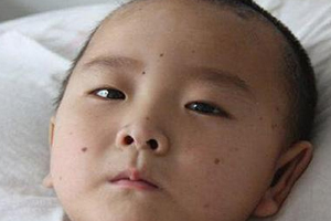 痣什么情況下會(huì)轉(zhuǎn)變?yōu)榱觯奎c(diǎn)痣不可取