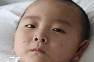 痣什么情況下會(huì)轉(zhuǎn)變?yōu)榱?？點(diǎn)痣不可取