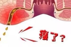 肛瘺非手術(shù)治療才可以嗎？手術(shù)是治療的關(guān)鍵途徑