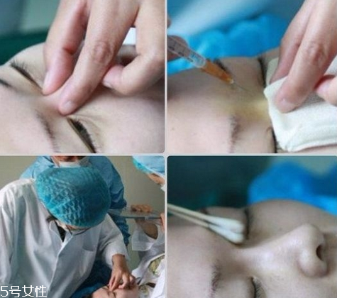 玻尿酸隆鼻維持時(shí)間受什么影響？玻尿酸不能過度注射