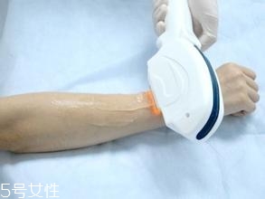 激光脫毛需要幾次？激光脫毛并不是終身有效的