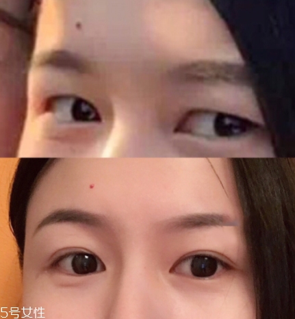 內(nèi)雙怎么進(jìn)化成雙眼皮？全是雙眼皮貼的功勞