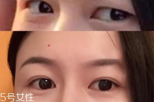 內(nèi)雙怎么進(jìn)化成雙眼皮？全是雙眼皮貼的功勞