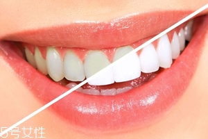 牙齒發(fā)黃是天生的嗎？只是你刷牙偷懶了