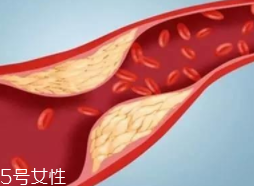 血管堵塞怎么自查？腿腳告訴你答案