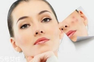 痘印多久能自行消失？多數(shù)人一年內(nèi)消失