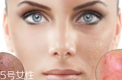 痘印多久能自行消失？多數(shù)人一年內(nèi)消失