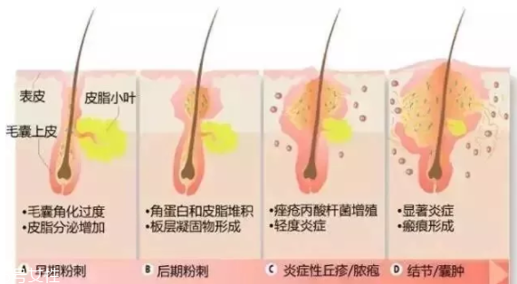 封閉性粉刺的發(fā)病機(jī)制是什么？角質(zhì)層太厚