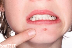 肌膚需要排毒嗎？長(zhǎng)痘并不代表排毒