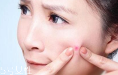 肌膚需要排毒嗎？長痘并不代表排毒