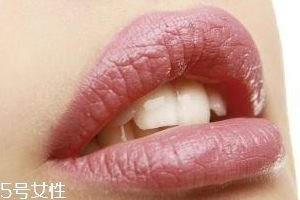 冬天爛嘴角什么原因？有可能營養(yǎng)不良