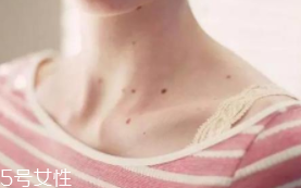 色素痣是腫瘤嗎？良性腫瘤不必擔心