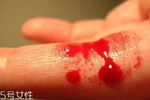 血友病的主要表現(xiàn)有哪些？出血是最明顯的特征