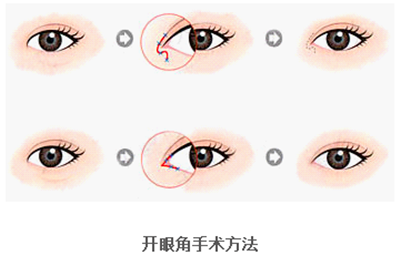 開眼角疤痕多久消失？開眼角的適宜人群