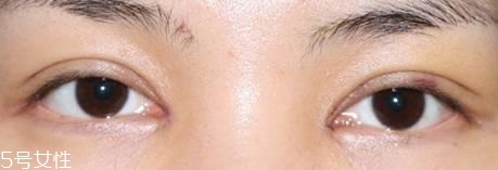 怎么縮短開眼角疤痕消失時間？雙眼皮開眼角恢復(fù)過程