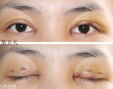 怎么縮短開眼角疤痕消失時間？雙眼皮開眼角恢復(fù)過程