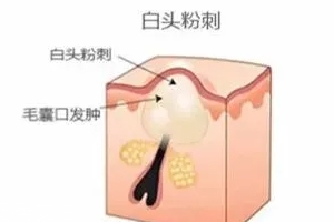 閉口是怎么引起的？4種情況要注意