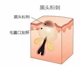 閉口是怎么引起的？4種情況要注意