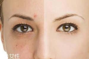 祛痘產(chǎn)品怎么選？先要分清痘印類型