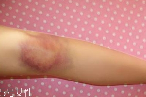 身體淤青怎么來的？不是磕碰那么簡單
