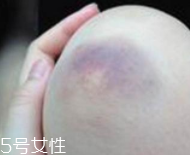 身體淤青怎么來的？不是磕碰那么簡單