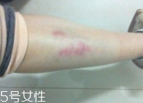 身體淤青怎么來的？不是磕碰那么簡單