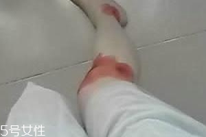 摔傷了涂什么藥好的快？做好消毒才能愈合快